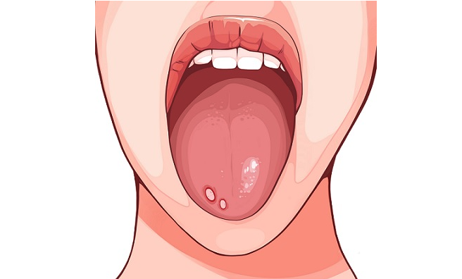 혓바늘 이미지